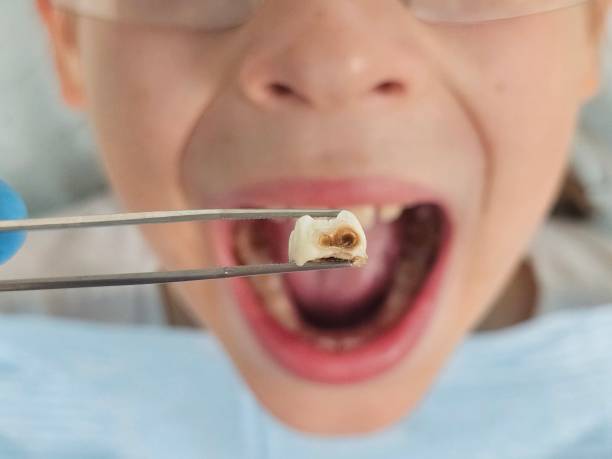Best Emergency Tooth Extraction  in Texkana, AR